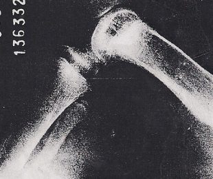 6 – Anormalidades do joelho no fêmur curto congênito