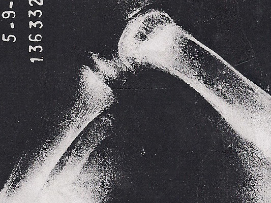 6 – Anormalidades do joelho no fêmur curto congênito