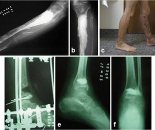 11 – Resposta de células-tronco de diferentes origens a biocerâmica de fosfato de cálcio bifásico
