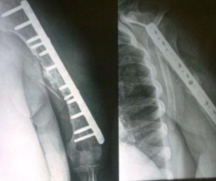 5 – Pseudartrose de úmero: tratamento com a técnica de Ilizarov