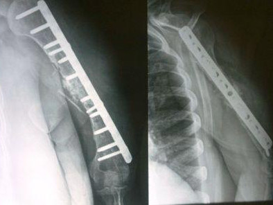 5 – Pseudartrose de úmero: tratamento com a técnica de Ilizarov