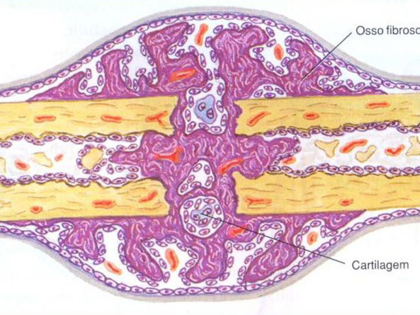 8 – Distúrbios da Consolidação Óssea: Tratamento com Transporte Ósseo