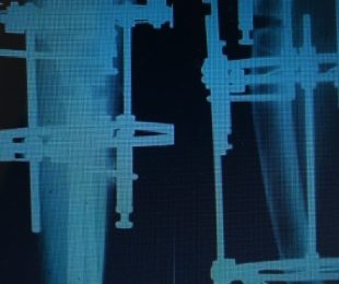 13 -Hemimelia Fibula