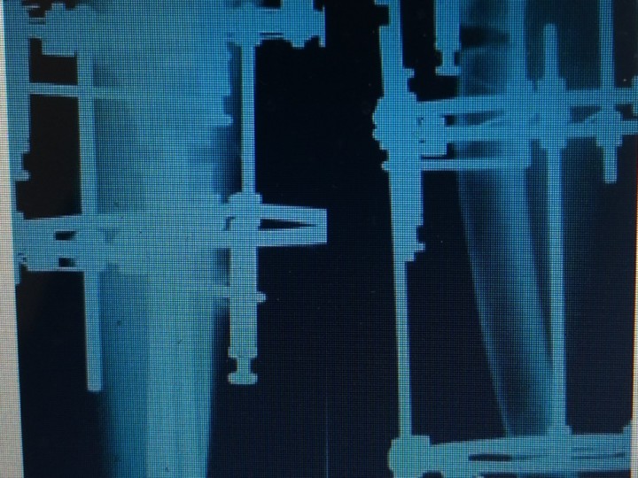 13 -Hemimelia Fibula