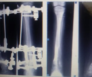 14- Fixação Externa nas Dismetrias dos Membros Inferiores
