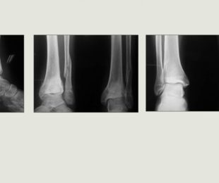 10 – Resumo dos Trabalhos do Congresso Mineiro de Ortopedia 2014