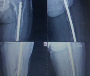 15- Pseudoartrose infectada