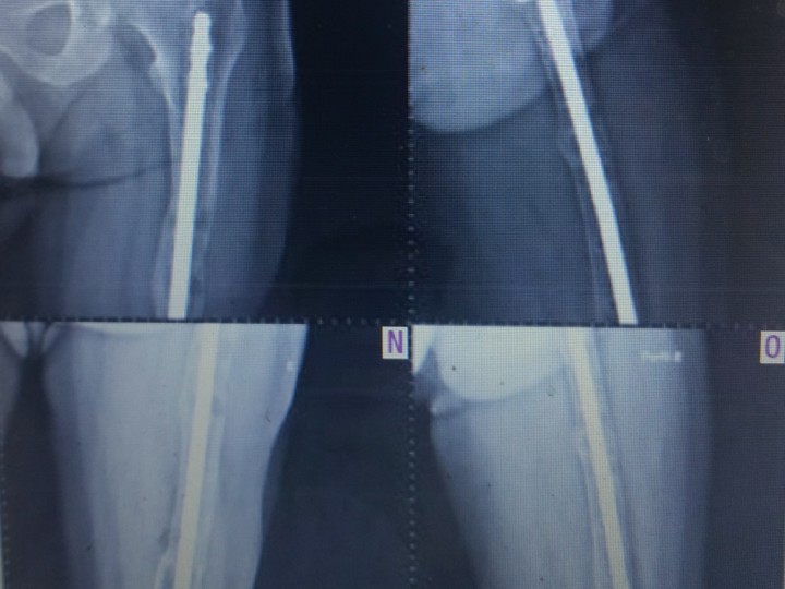 15- Pseudoartrose infectada