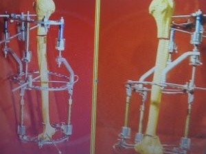 16- Pseudartrose umero= tratamento com a fixação externa de ILIzarov