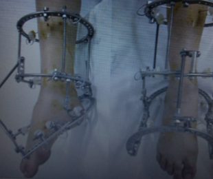 17- TÉCNICA DE FIXAÇÃO PARA TRATAMENTO DE DEFORMIDADES EM EQUINO COM O MÉTODO DE ILIZAROV