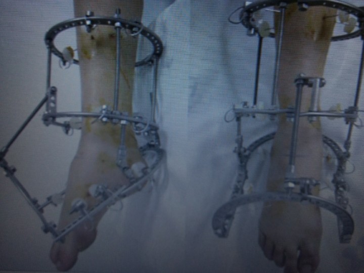 17- TÉCNICA DE FIXAÇÃO PARA TRATAMENTO DE DEFORMIDADES EM EQUINO COM O MÉTODO DE ILIZAROV