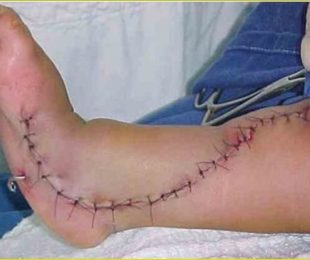 1 – Hemimelia Tibial: Reconstrução e alongamento ósseo como tratamento