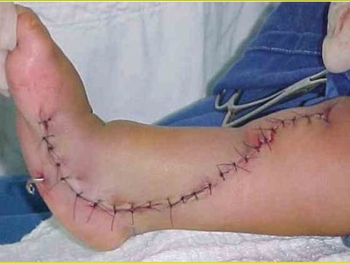 1 – Hemimelia Tibial: Reconstrução e alongamento ósseo como tratamento