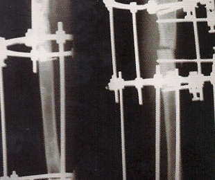 2 – O Tratamento das deformidades angulares dos membros com fixador externo