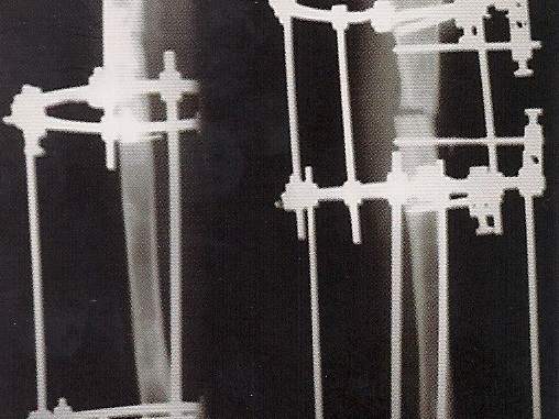 2 – O Tratamento das deformidades angulares dos membros com fixador externo