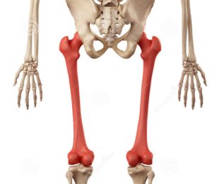 3 – Alongamento ósseo com Método de Ilizarov em  paciente com fêmur curto congênito