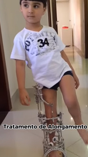 Quebrando Paradigmas – Caso de Agenesia da Tíbia e Patela