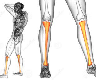 4 –RBO( Revista Brasileira de Ortopedia ) – Transporte ósseo da tíbia com Método de Ilizarov nos casos de pseudartrose com falha óssea