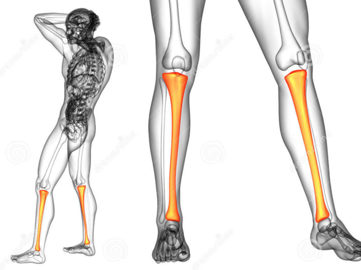 4 –RBO( Revista Brasileira de Ortopedia ) – Transporte ósseo da tíbia com Método de Ilizarov nos casos de pseudartrose com falha óssea